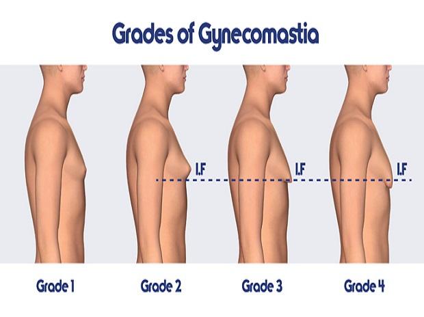 Gynecomastia Grades