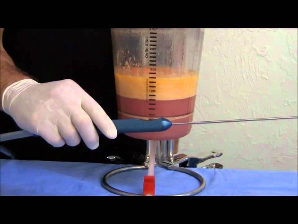 Liposuction Canister